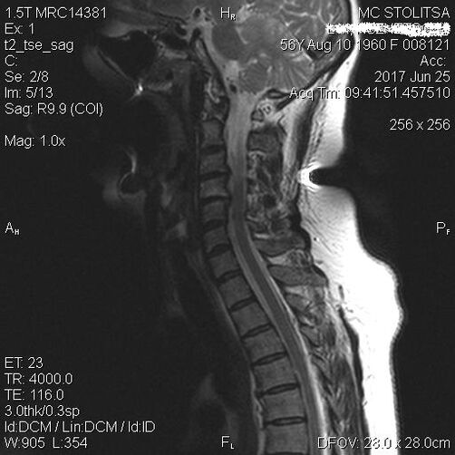 Bizkarrezurraren bizkarrezurraren osteokondrosia eta spondilosia