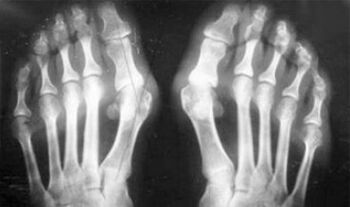 Artritisaren eta artrosiaren sintomen diagnostiko diferentziala